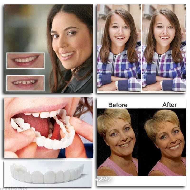 🎉Last Days 65%OFF 🎉Snap-On Dentures